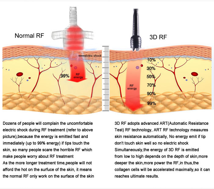 Tappen Buchhandlung Anbinden Radio Frequency Treatment Warum Nicht Kubisch Trainer